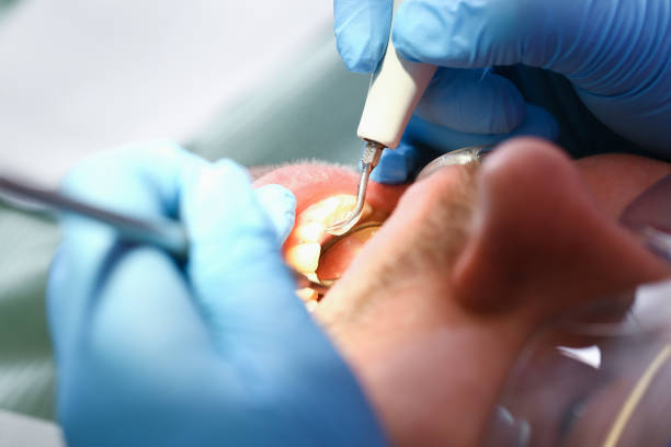 Best Emergency Treatment for Dental Infections or Abscesses in Lebanon, TN
